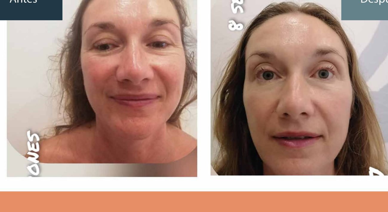 Antes y después facial